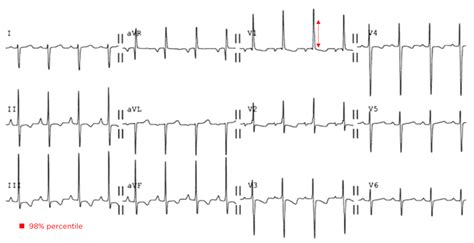 rvh differential diagnosis