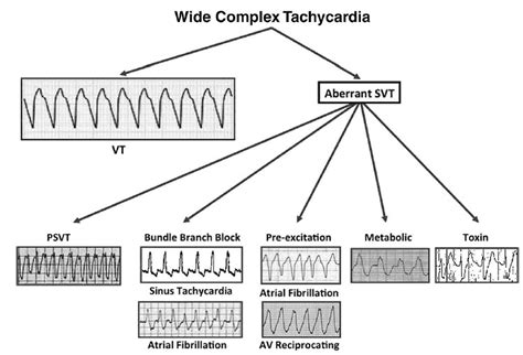 Types Of Ventricular Tachycardia