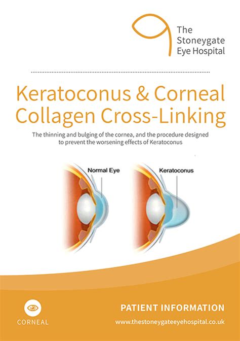 Keratoconus The Stoneygate Eye Hospital Leicester