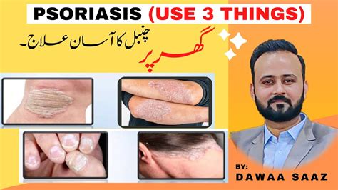 What Is Psoriasis And Treatment At Home Chambal Ka Ilaaj Ghar Par