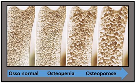 Osteoporose E Osteopenia Medicina De Excel Ncia