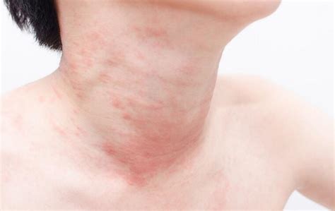 Rash On Neck Causes Symptoms And Treatment