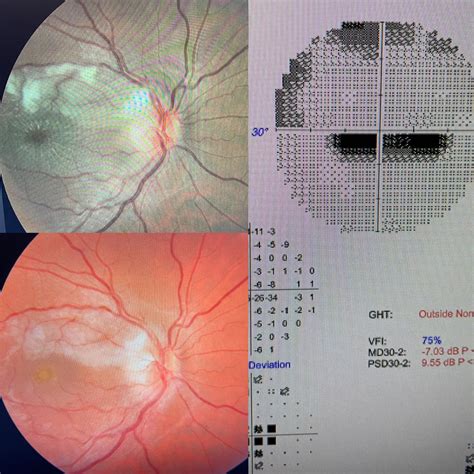 34 Yo Acute Vision Loss Od Noticed One Day After Lower Extremity