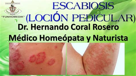 Escabiosis LociÓn Pedicular Enfermedad Causada Por Un Ácaro Conocido