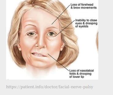 Facial Nerve Paralysis Treatment Service in Vijayawada | ID: 19713278712