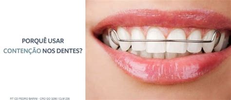 O Que É Contenção No Dente - Contenção de dente: o que é e quando usar | Barini Odontologia