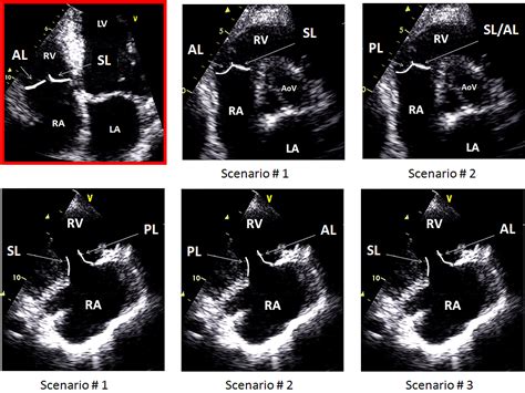 Anatomy of tricuspid valve