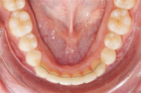 Le Fil De Contention En Orthodontie