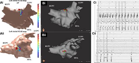 Prospective Star Guided Ablation In Persistent Atrial Fibrillation