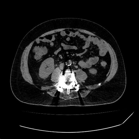 Amoebic Liver Abscess Image