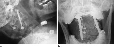 Odontoid Fracture Fixation A Lateral Radiograph Of The Cervical