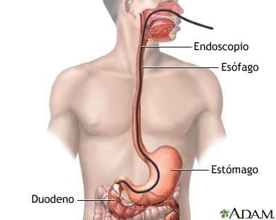 Qué es la Endoscopia Superior CEGA