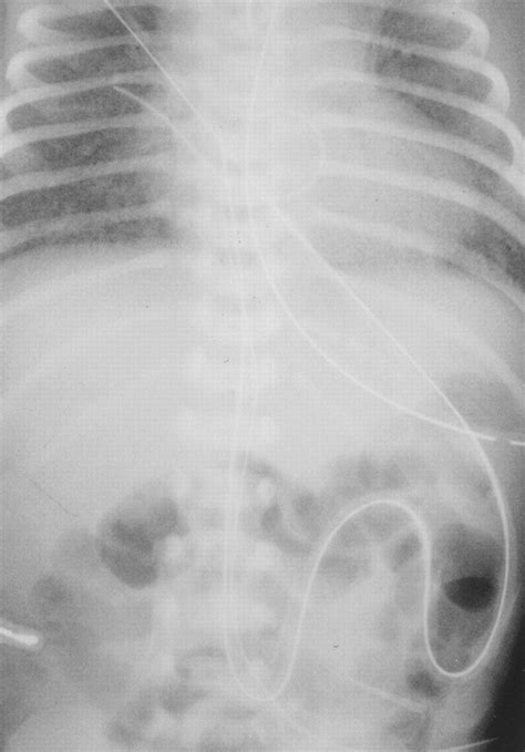 Neonates And Umbilical Venous Catheters Normal Appearance Anomalous