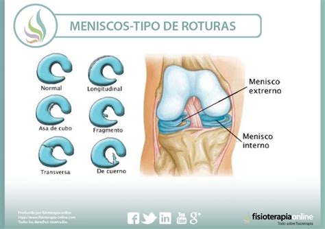 Rotura De Menisco Qu Es Causas S Ntomas Tratamiento Y Consejos