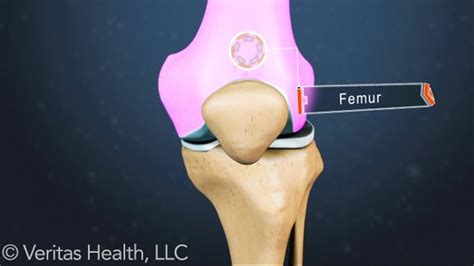 Symptoms of Kneecap Dislocation | Diet plans for men, Dislocation, Knee injury