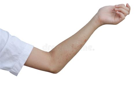 Red rash on the arms stock image. Image of infestation - 106704087