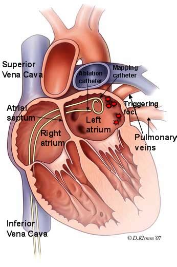 Atrial Fibrillation Afib Treatment In Washington Dc Maryland