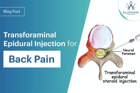 Back Pain Treatment Pain Management Transforaminal Epidural Injection