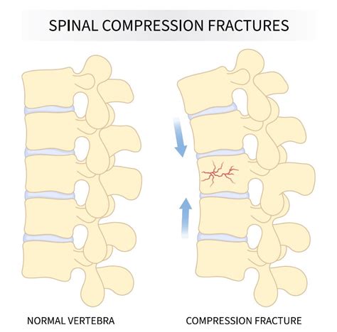 Understanding the Causes of Vertebral Compression Fractures