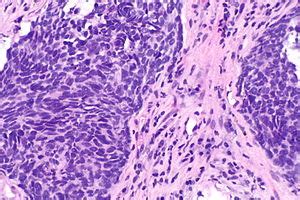 Non-small cell lung carcinoma - Libre Pathology