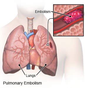 Pulmonary Embolism - What You Need to Know