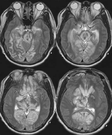 After Bifrontal Decompressive Craniectomy Fluid Attenuated Inversion Download Scientific