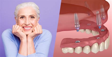 full mouth dental implants Houston Texas