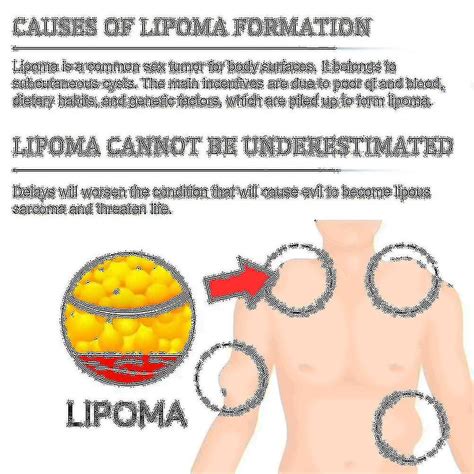 Lipoma Removal Patch For Body Herbal Lipoma Removal Patches Lymphatic