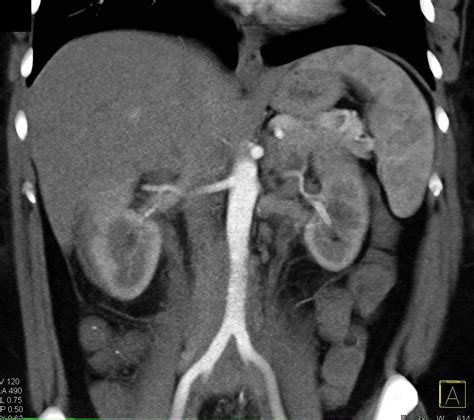 Retroperitoneal Fibrosis With Bilateral Hydronephrosis Kidney Case