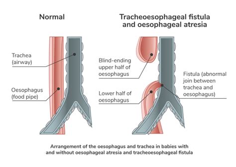 Oesophageal Atresia Csor Npeu