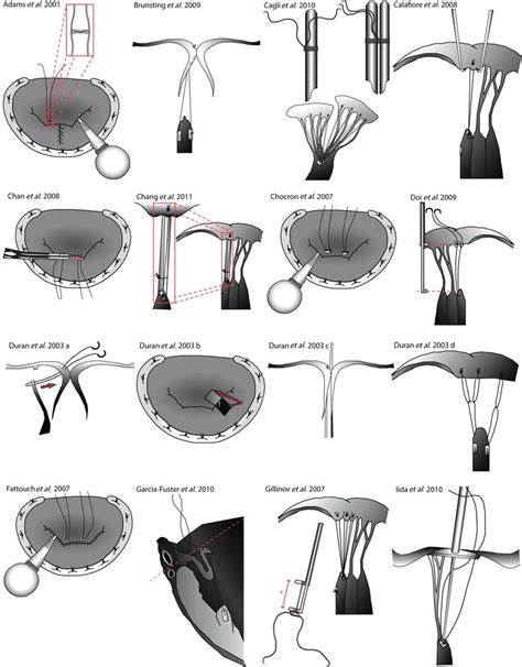 A Techniques For The Repair Of The Anterior Mitral Leaflet The Figure Download Scientific