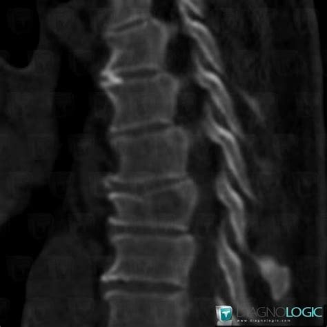 Radiology case : Hemangioma (MRI ,CT) - Diagnologic