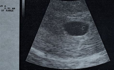 6 Week Ultrasound Heartbeat