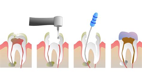 What Is Root Canal Treatment And What Is The Procedure Smile