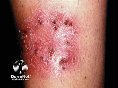 Tinea Corporis Body Ringworm — Dermnet