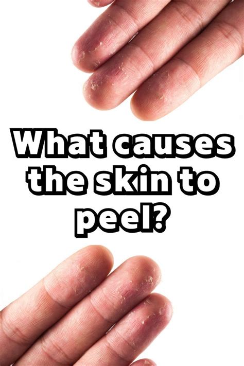 Whats The Vitamin Deficiency Causing Peeling Skin On Fingertips