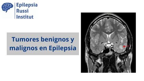 Cirug A Tumores Cerebrales Archivos Viviendo Con Epilepsiaviviendo