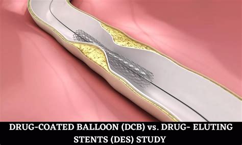 Drug Coated Balloon Angioplasty Safe Alternative To Stent For Heart