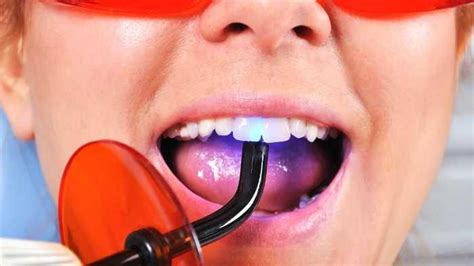 How Long Do Composite Fillings Last In Seattle Wa Dentistry