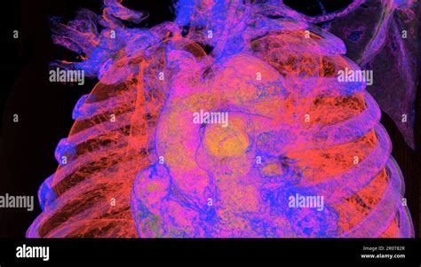 Bovine aortic arch variant, CT scan Stock Photo - Alamy