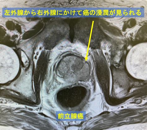 血精液症精子・精液に血液が混じるの原因・検査・治療について 東京都新橋駅徒歩1分の泌尿器科クリニック