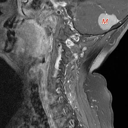 Spinal Schwannoma Cervical Image Radiopaedia Org