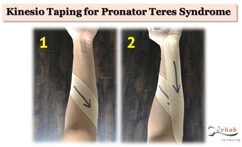 Rehabilitation For Pronator Syndrome Rehab For A Better Life