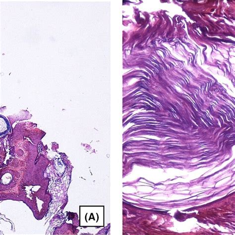 Histopathologic Findings A Lowpower View Of Hyperkeratosis With