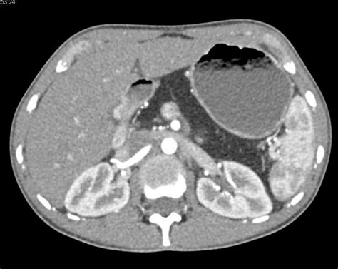 Cystic Fibrosis With Fatty Replacement Of The Pancreas Pancreas Case