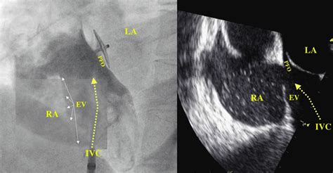 Pfo By Fluoroscopy And Tee Download Scientific Diagram