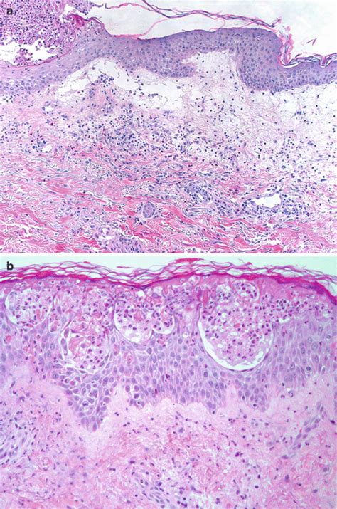 Acute Generalized Exanthematous Pustulosis Histology