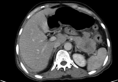 Pancreatic cancer presenting as a Sister Mary Joseph's nodule | BMJ