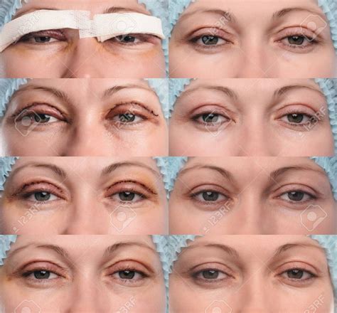 Blefaroplastia superior Recomendaciones y Guía 2024