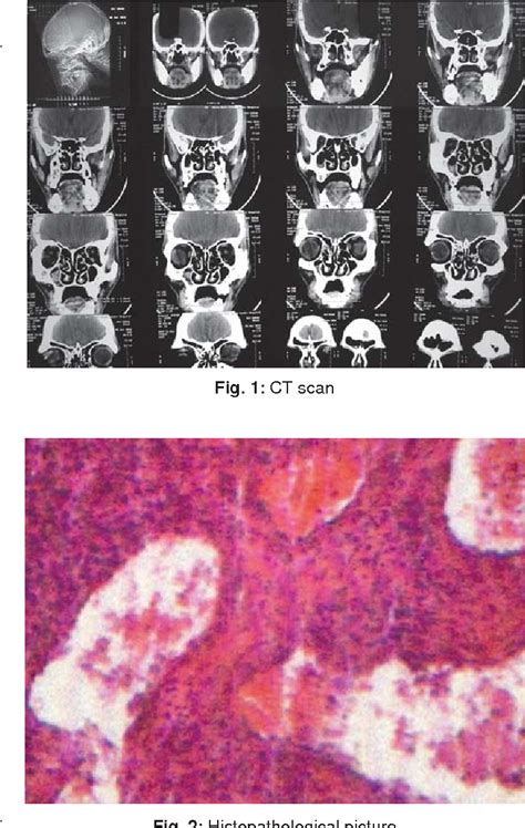 Figure 1 from Lobular Capillary Hemangioma of Nasal Cavity | Semantic Scholar